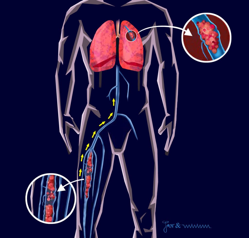 Arquivo Dr. Fabio Rossi Embolia Pulmonar