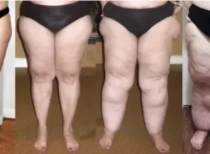 Imagem-enviada-pelo-Dr.-Mauro---Credito-SBACV-Nacional---Release-Lipedema-junho-2023