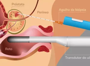 Câncer de Próstata