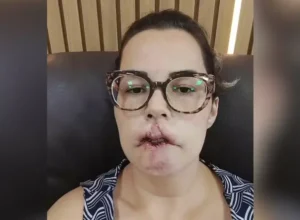 A influenciadora perdeu os lábios após um procedimento estético Reprodução/Redes Sociais