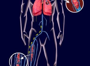 Arquivo Dr. Fabio Rossi Embolia Pulmonar